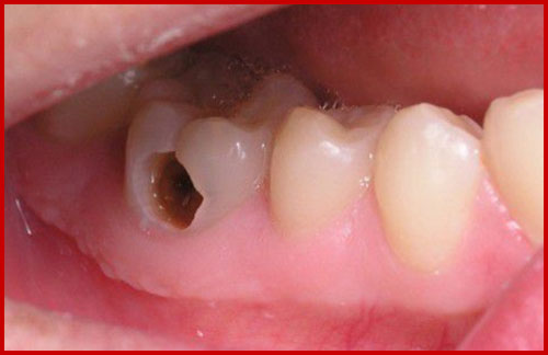 Ảnh hưởng khi răng khôn bị mọc lệch 3