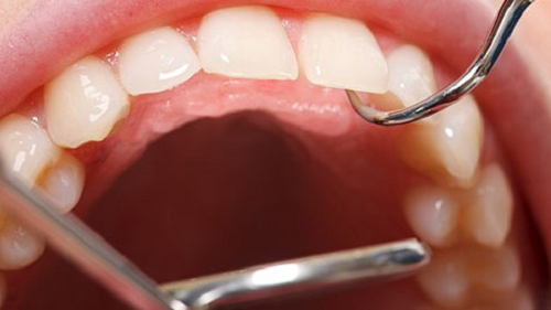 Cạo vôi răng có nguy hiểm không? 2