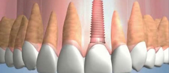 kỹ thuật cấy ghép răng implant