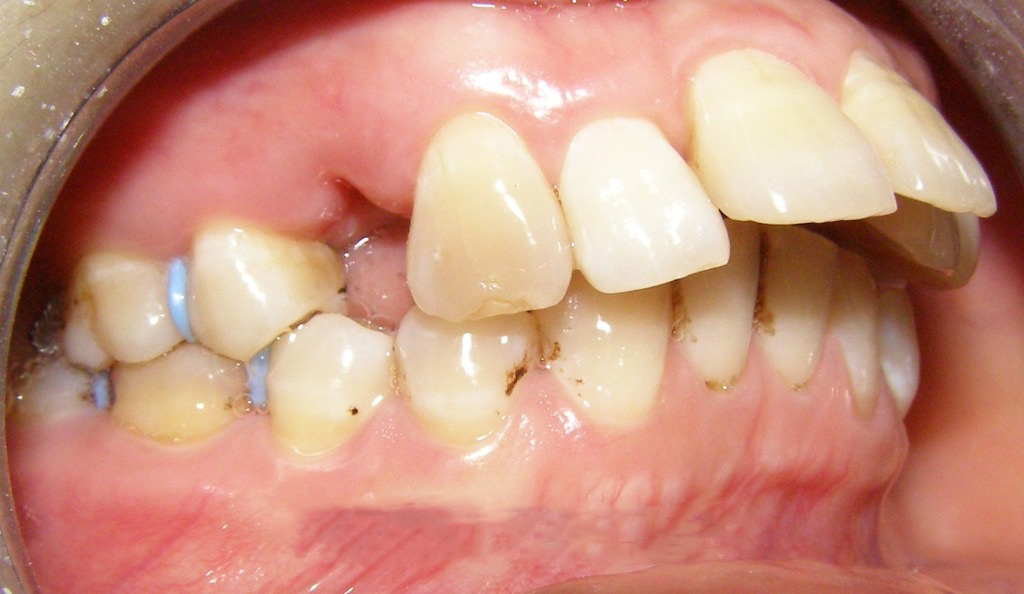 Phẫu thuật hàm hô không cần niềng răng