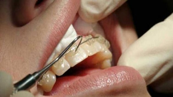 quy trình niềng răng