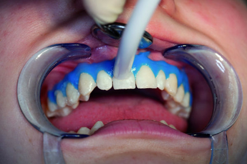 Phương pháp tẩy trắng răng an toàn