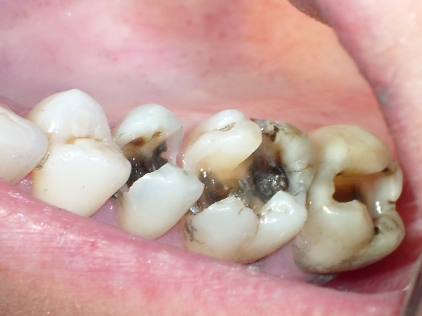Bọc răng sứ cho răng hàm để đảm bảo sức khoẻ