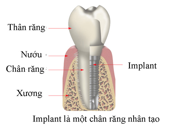 cay-ghep-implant-o-dau-tot-tai-tphcm-1