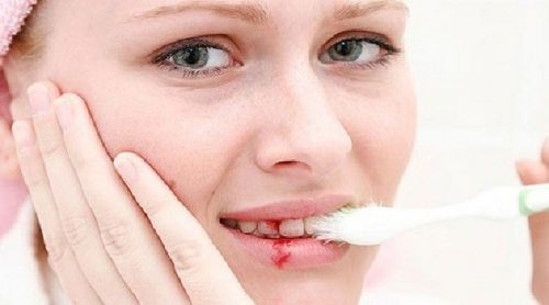Chảy máu chân răng là dấu hiệu của bệnh gì? 2