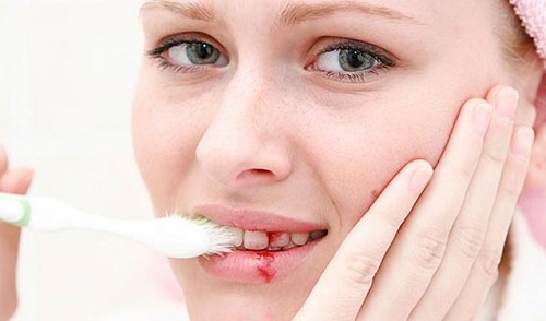 Chảy máu chân răng nên uống thuốc gì để điều trị? 1