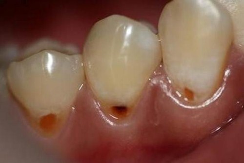 Quy trình bọc răng sứ cho răng sâu