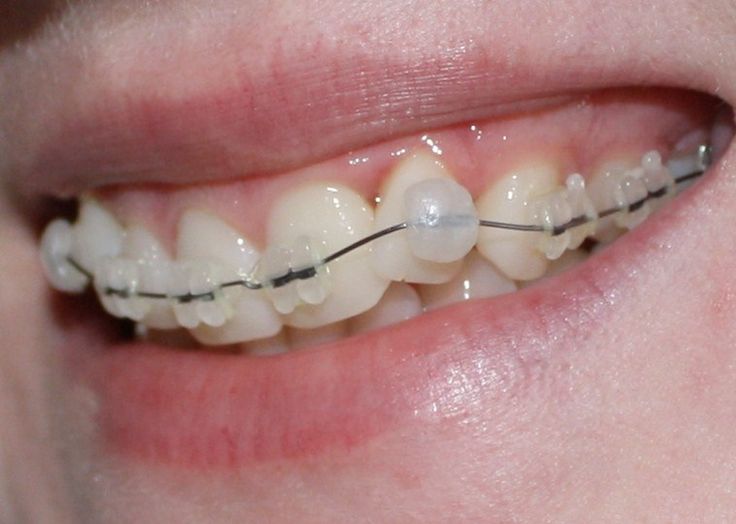 Quy trình niềng răng khểnh an toàn hiệu quả