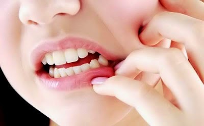 Răng khôn bị lung lay phải làm sao? 2