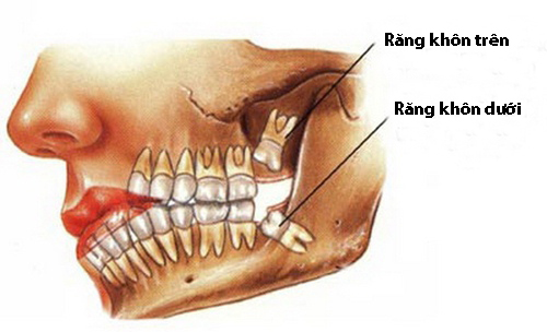 Răng khôn hàm dưới mọc lệch 1