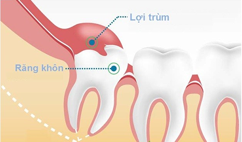 Răng khôn hàm dưới mọc lệch 2