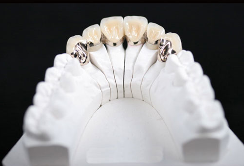 Răng sứ kim loại thường có tốt không? 1