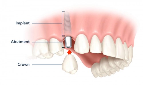 Trồng răng Implant có nguy hiểm không?
