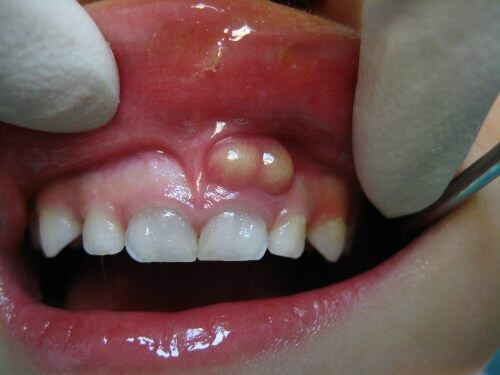 Viêm chân răng có mủ và cách điều trị 2