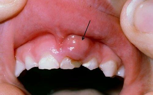 Viêm chân răng ở trẻ em và những điều phụ huynh nên biết 1
