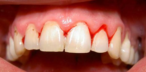 Viêm chân răng và cách điều trị 2