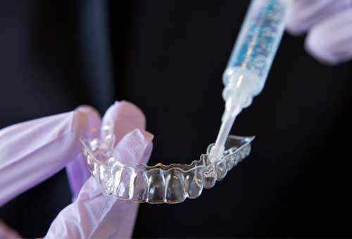 Quy trình tẩy trắng răng tại nhà như thế nào?
