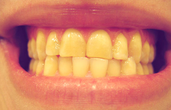 Răng vàng có tẩy trắng được không?