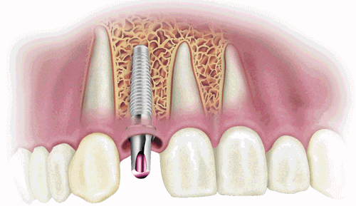 Trồng răng vĩnh viễn bằng kỹ thuật cấy ghép implant