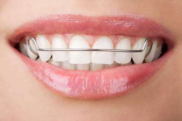 Niềng răng 1 hàm có hiệu quả không?